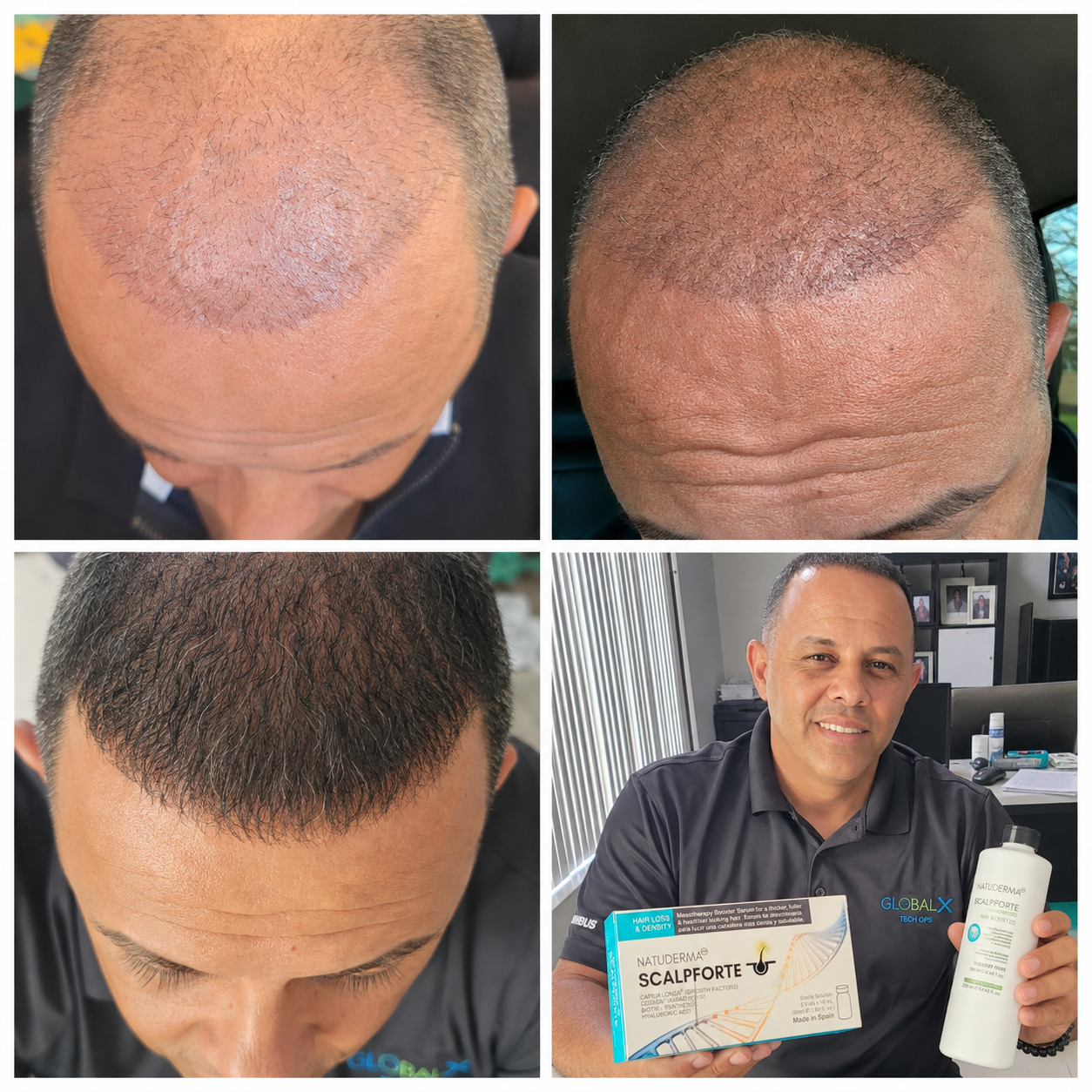 SCALPFORTE Exosomes Hair Loss & Growth - Microneedling & Mesotherapy Serum